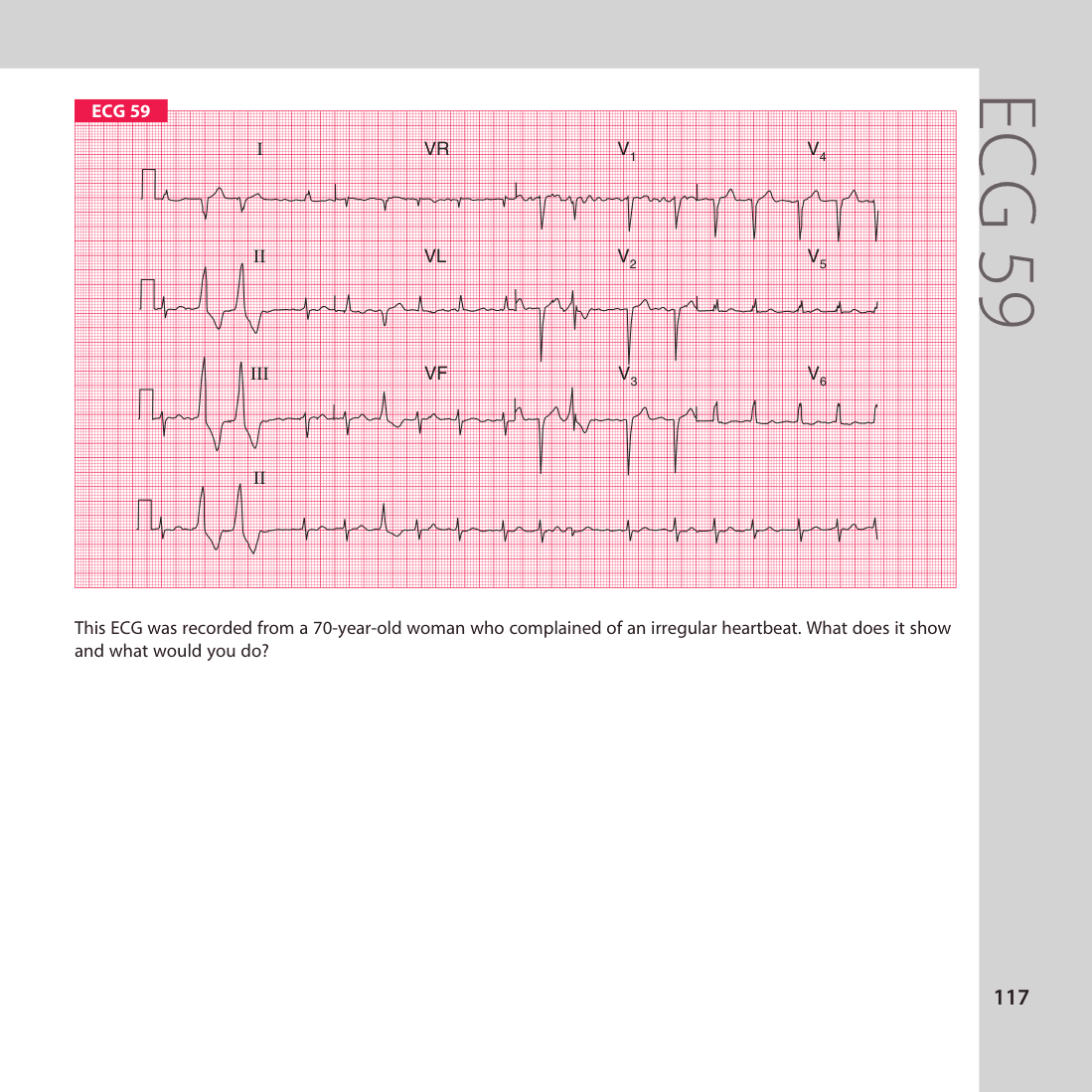 ECG 59