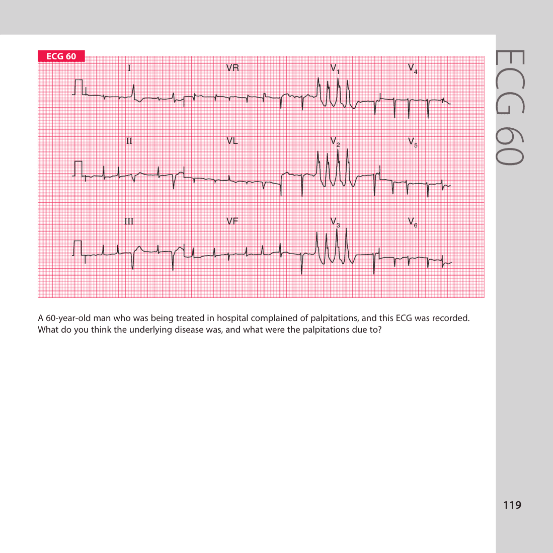 ECG 60