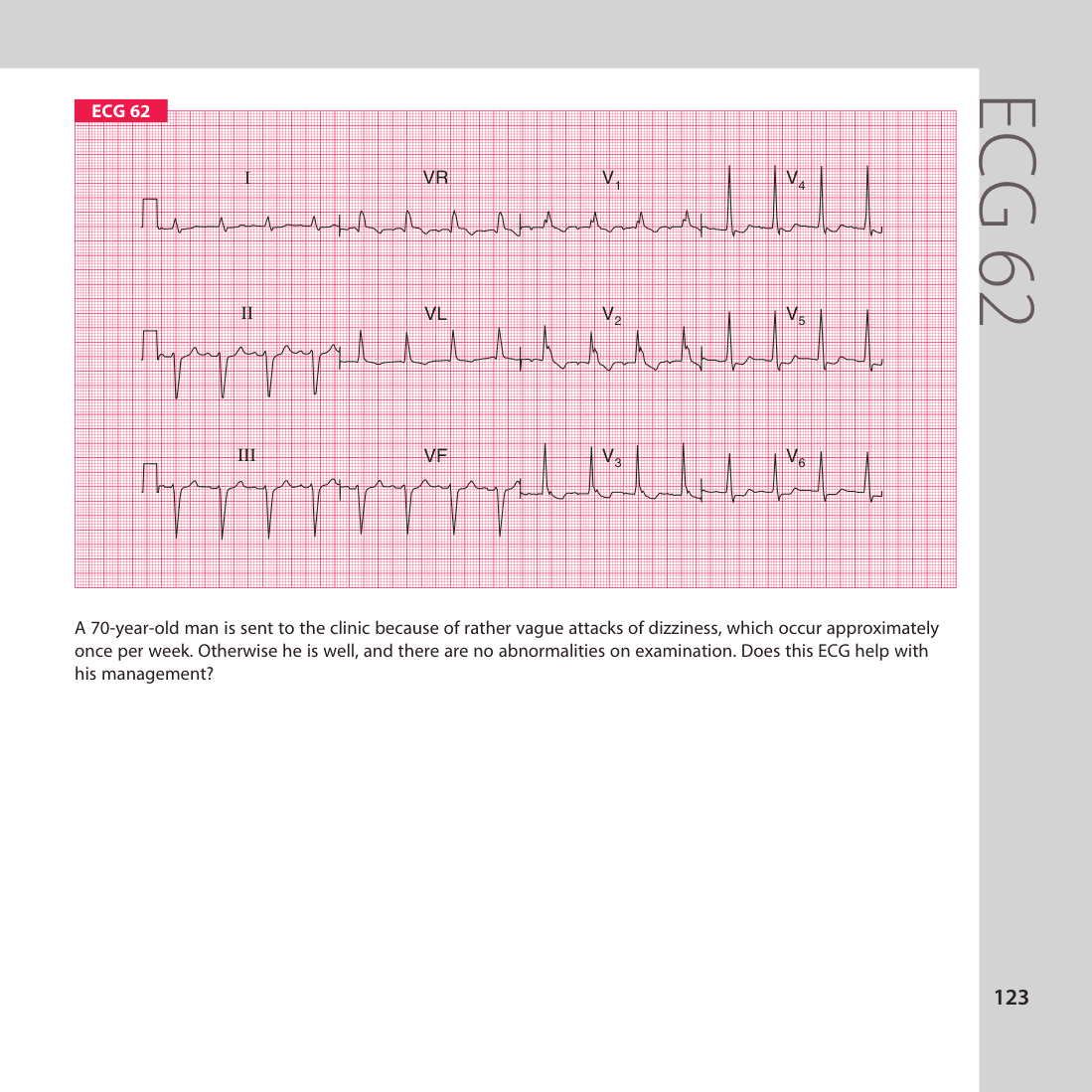 ECG 62