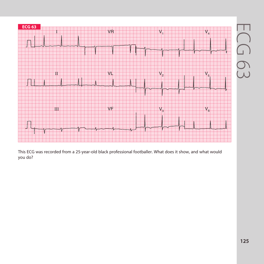 ECG 63