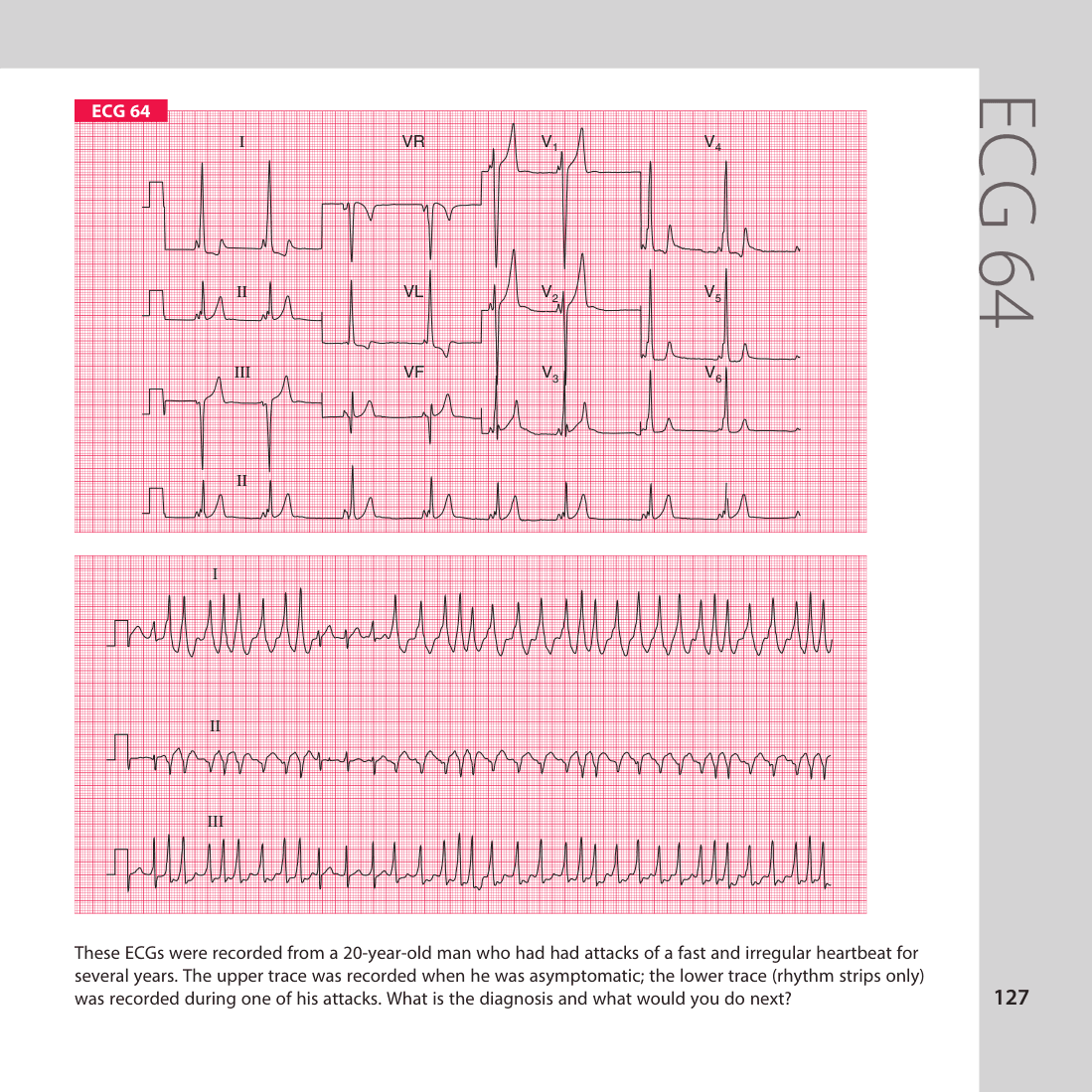 ECG 64