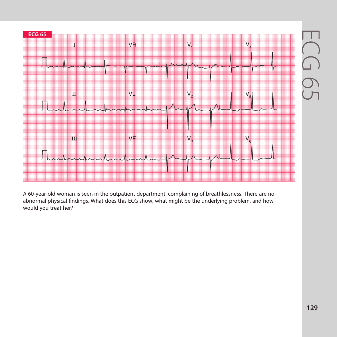 ECG 65