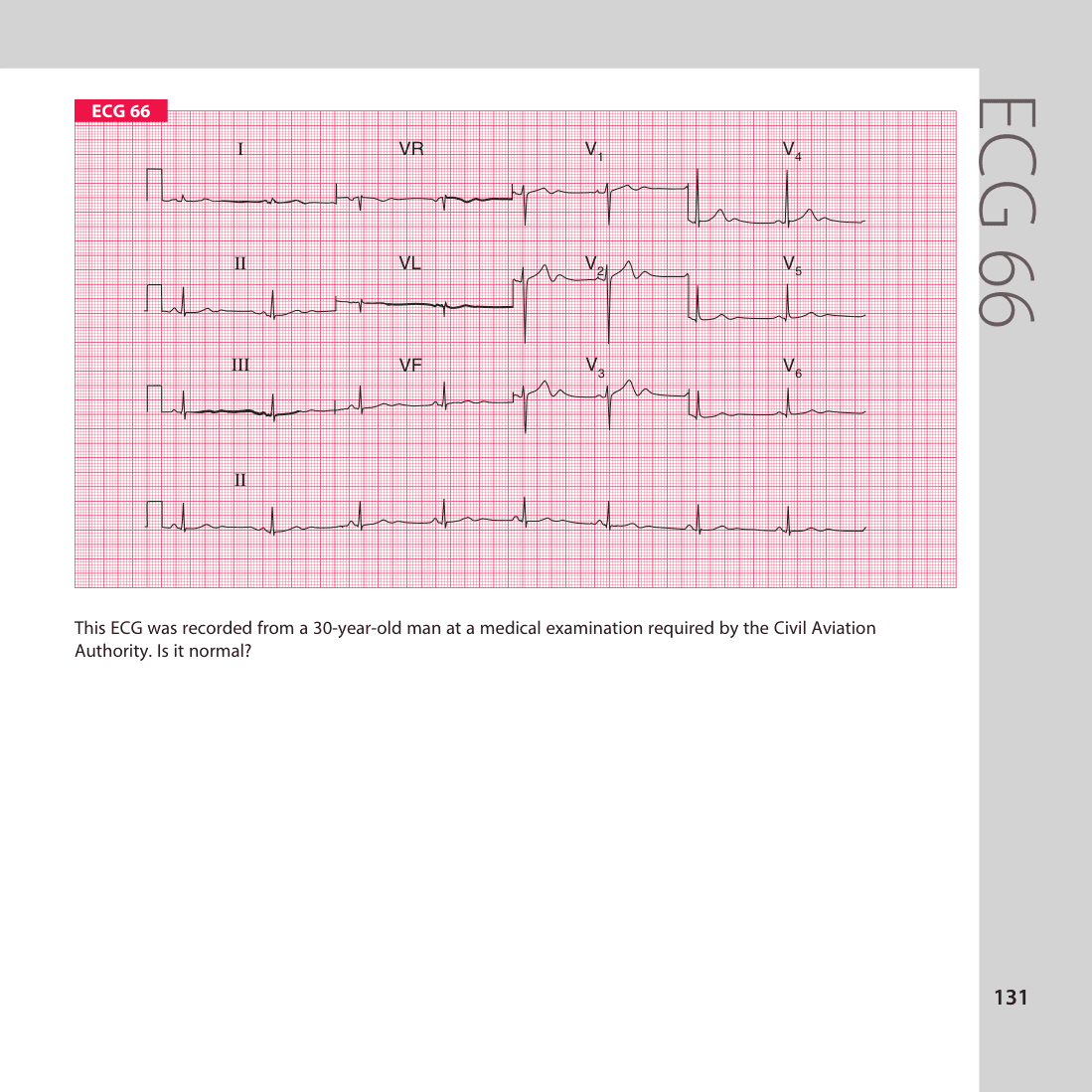 ECG 66