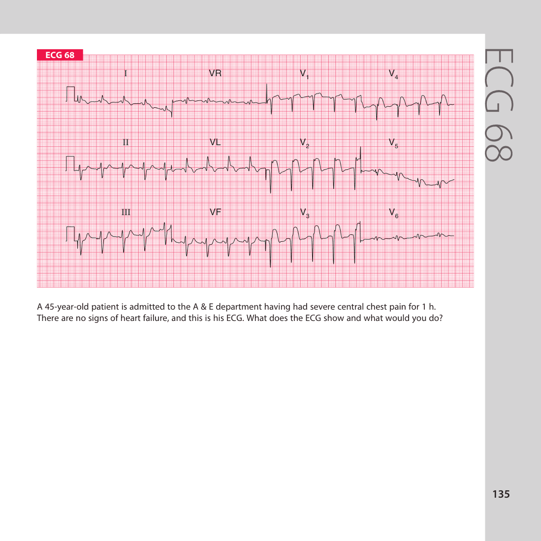 ECG 68