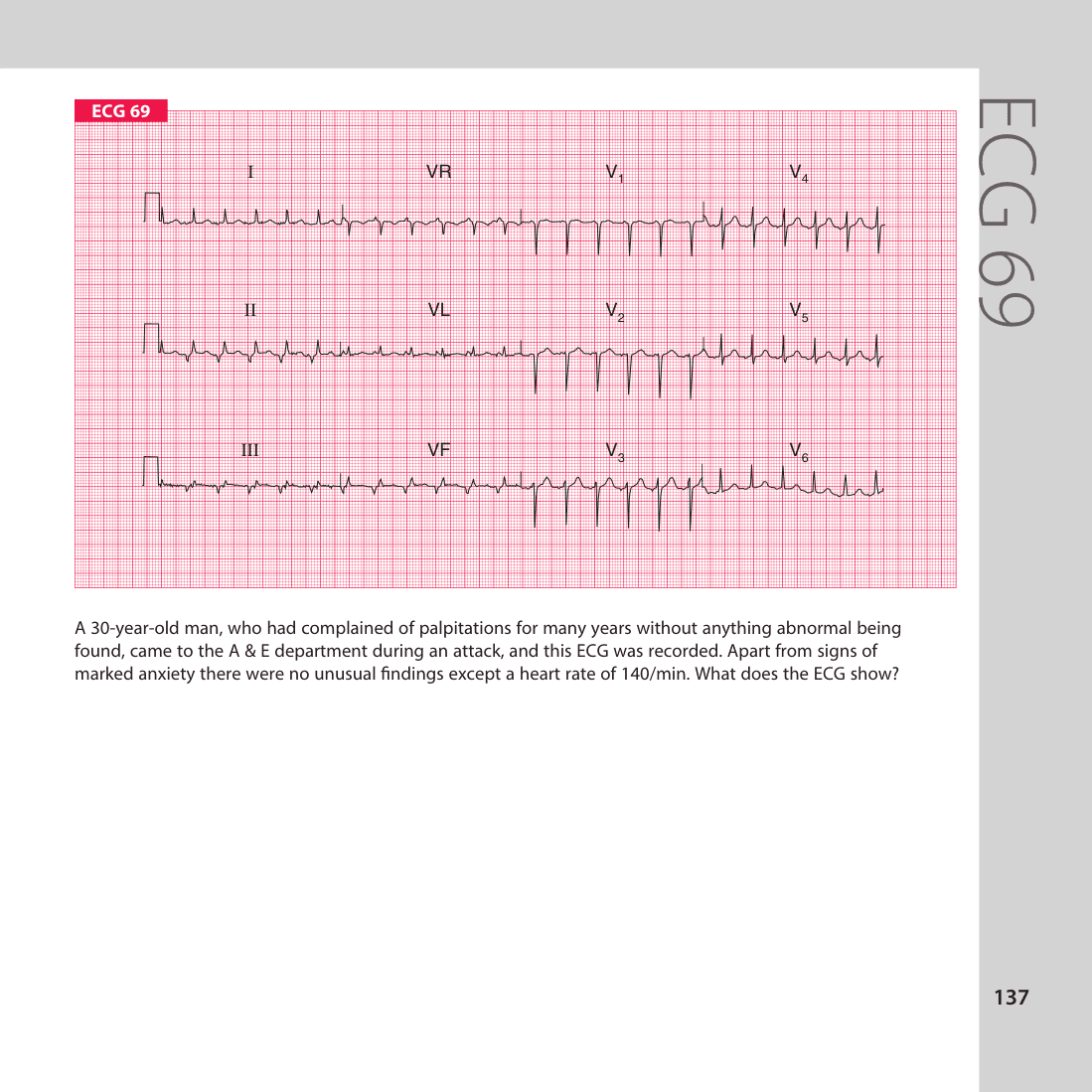 ECG 69