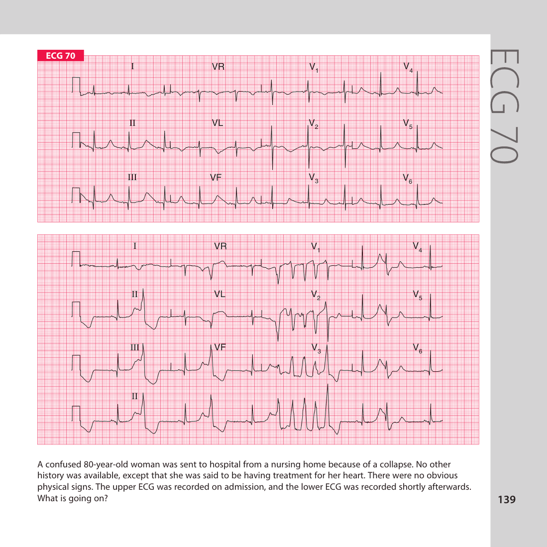 ECG 70