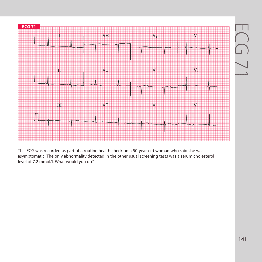 ECG 71