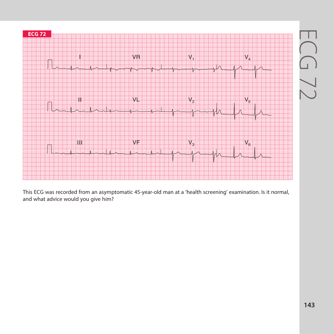 ECG 72