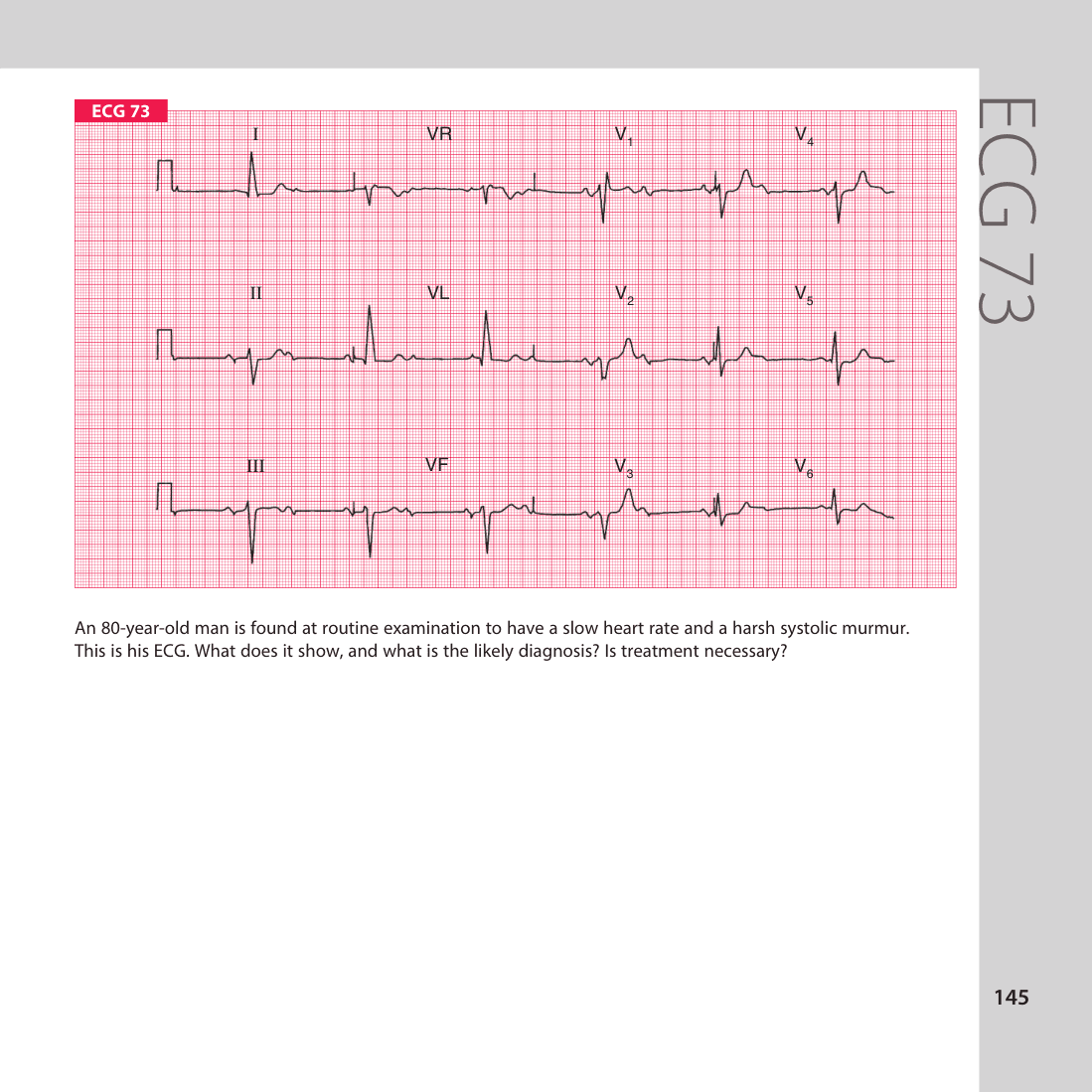 ECG 73
