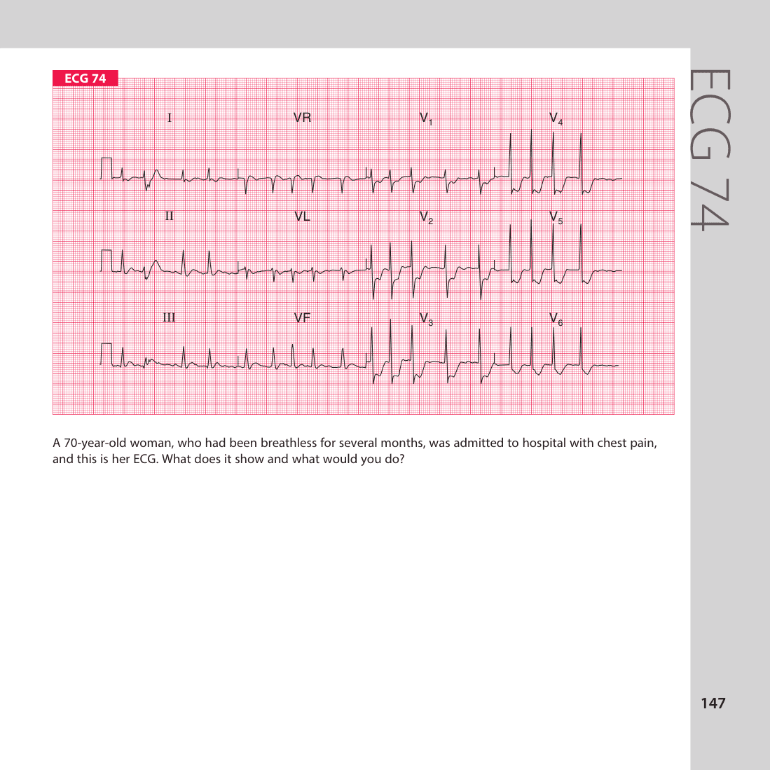 ECG 74