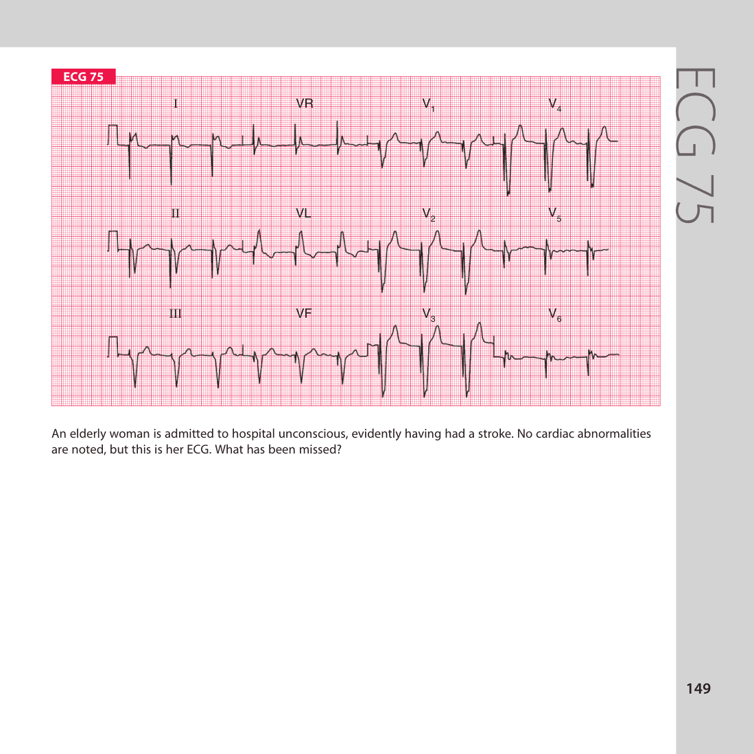 ECG 75