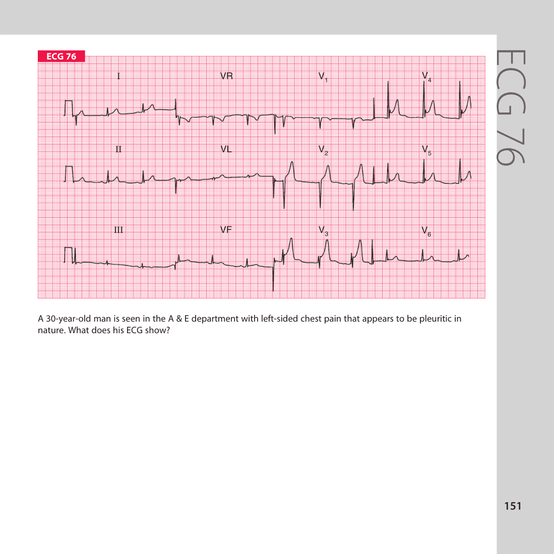 ECG 76