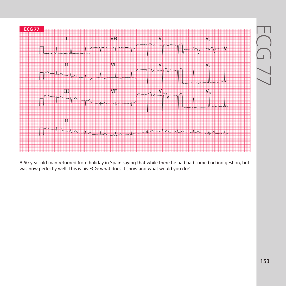 ECG 77