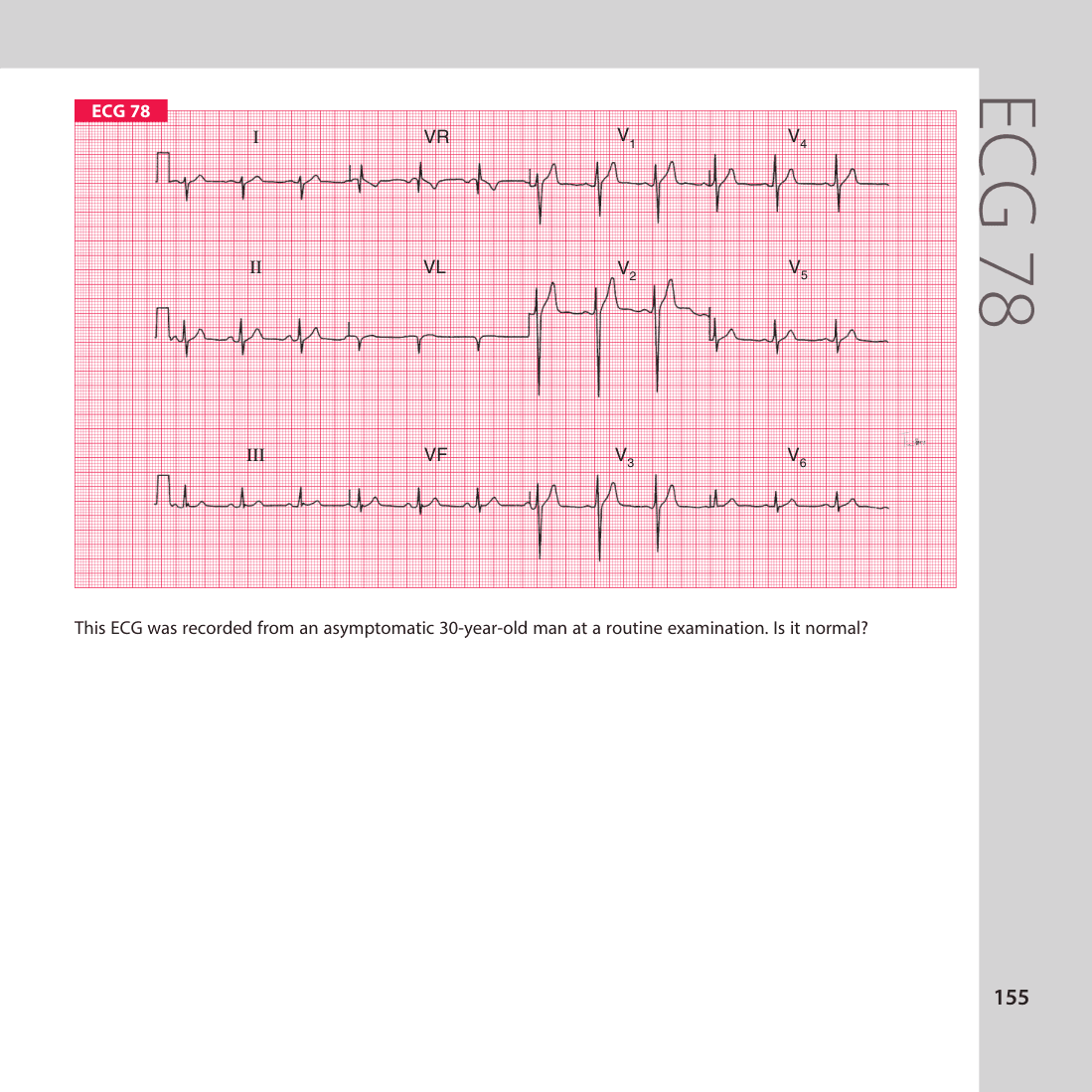 ECG 78