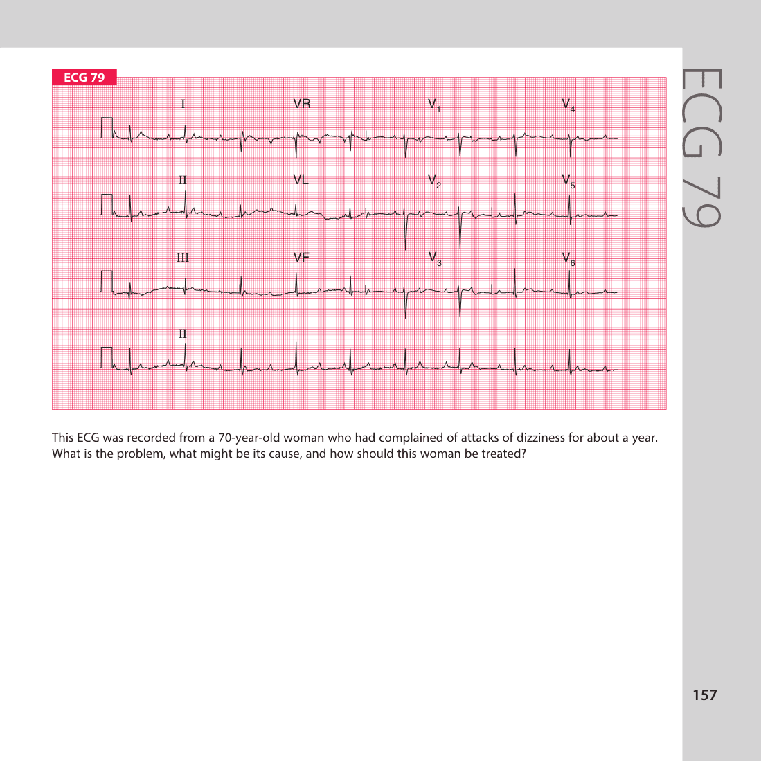 ECG 79