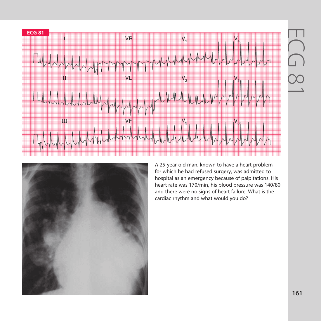 ECG 81