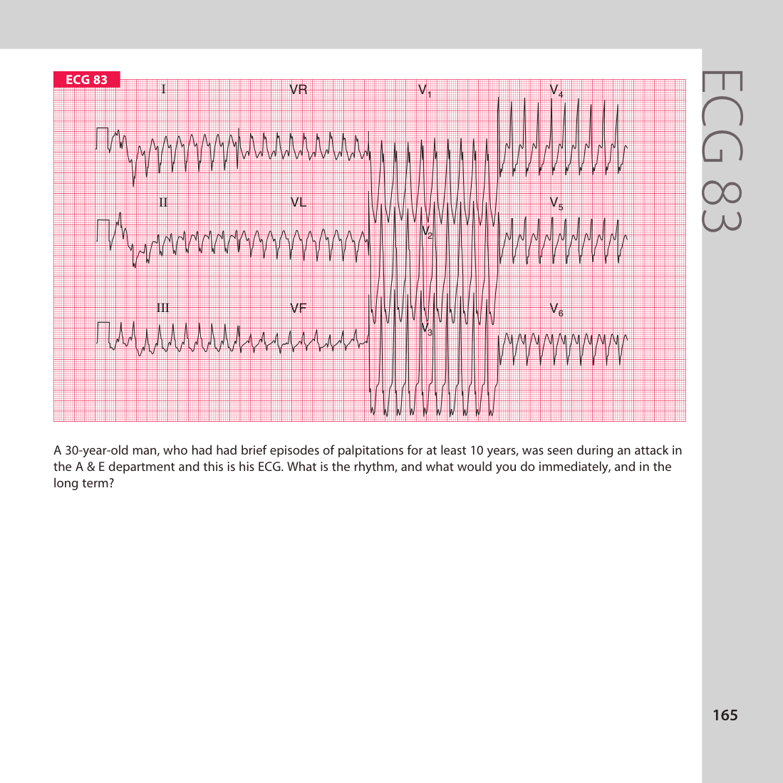 ECG 83