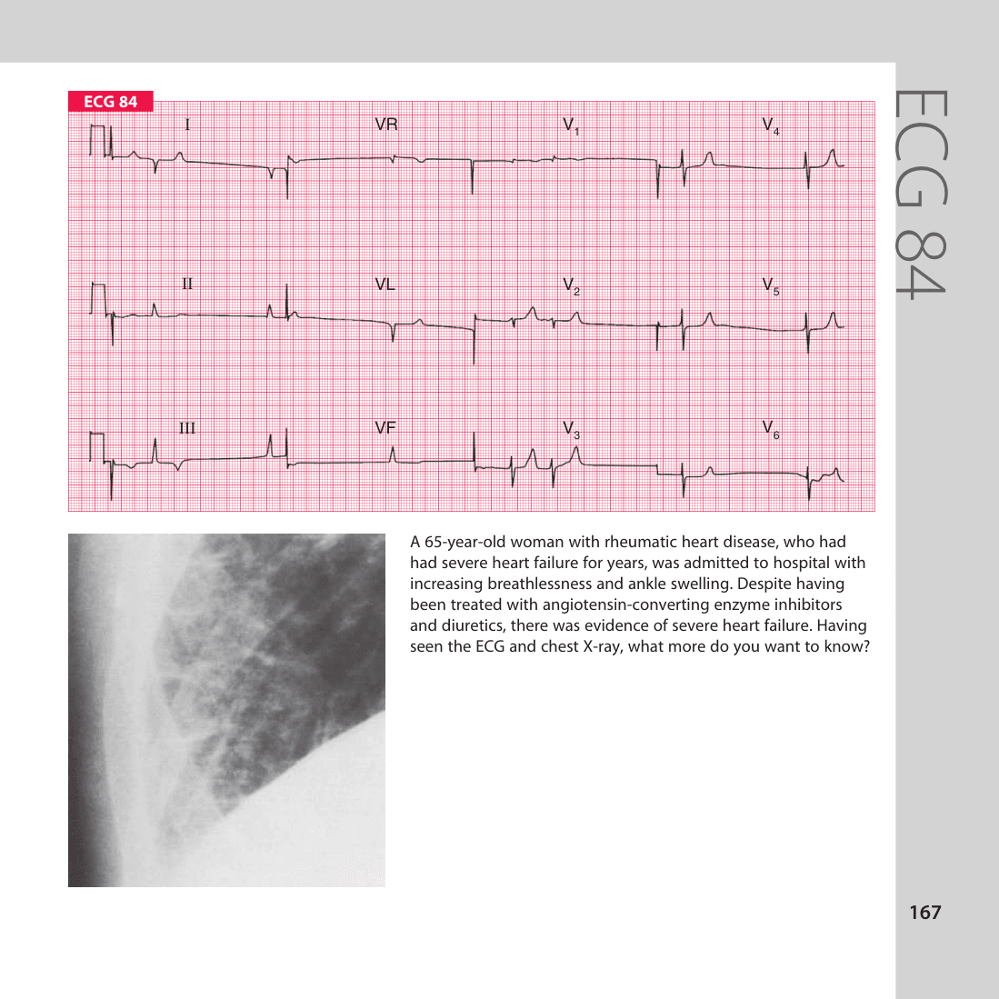 ECG 84