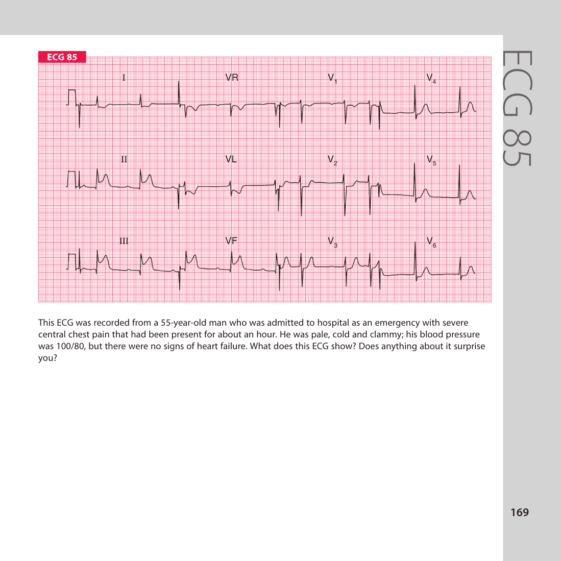 ECG 85