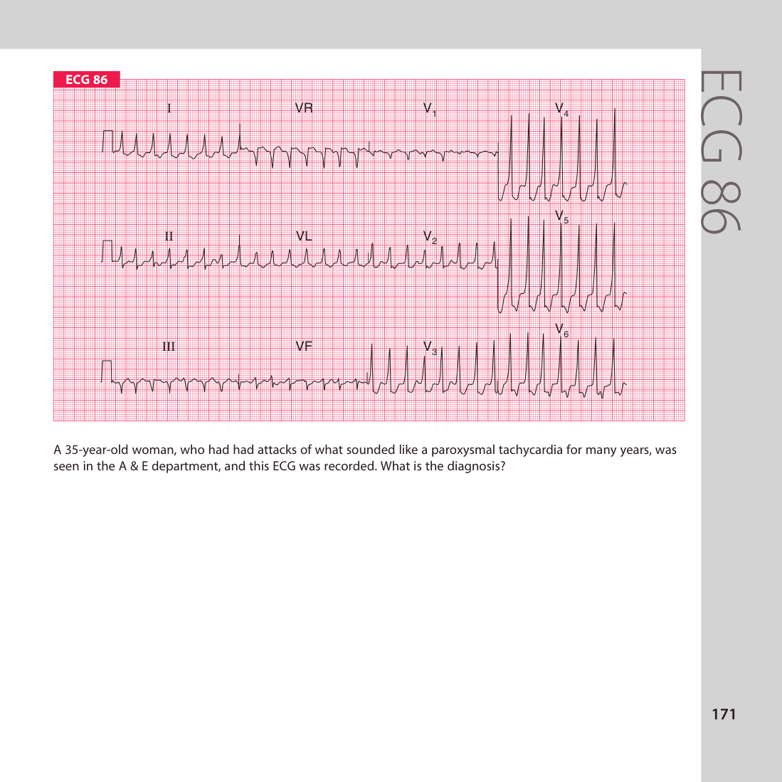 ECG 86