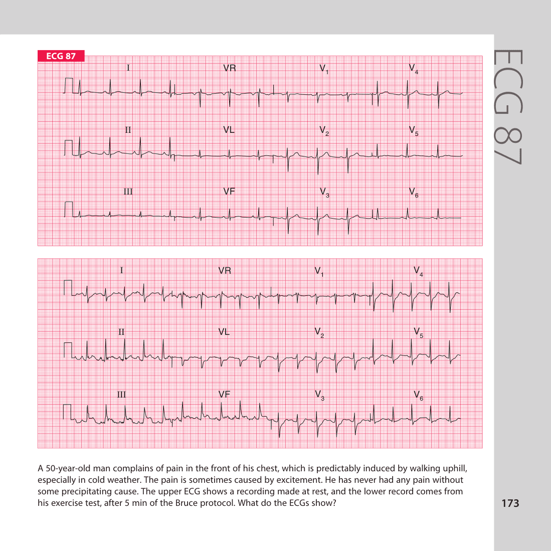 ECG 87