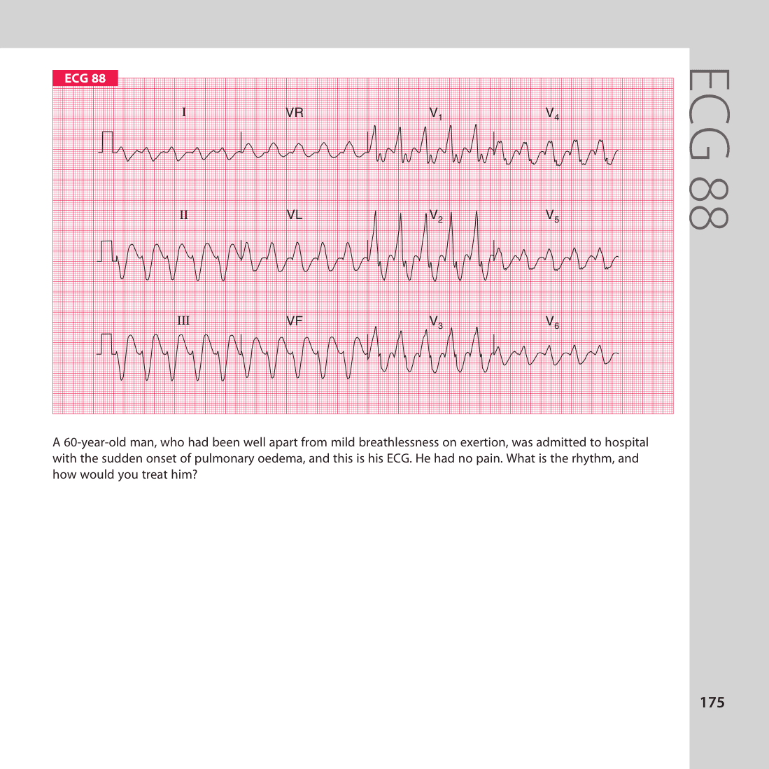 ECG 88