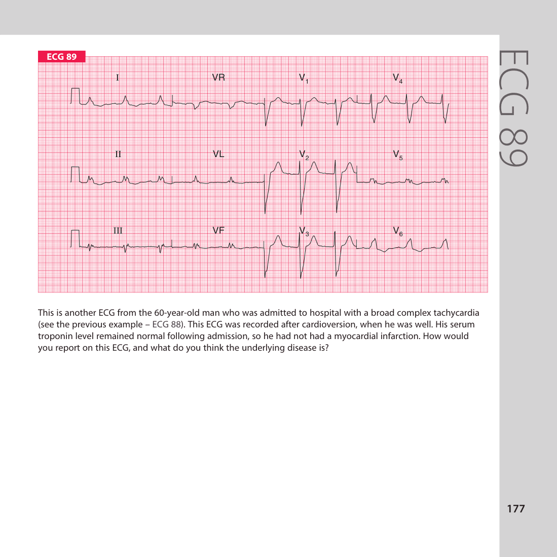 ECG 89