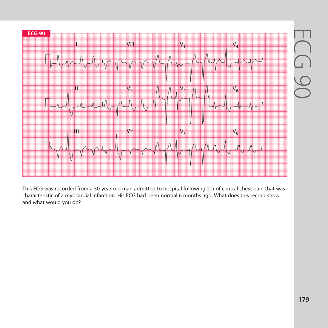 ECG 90