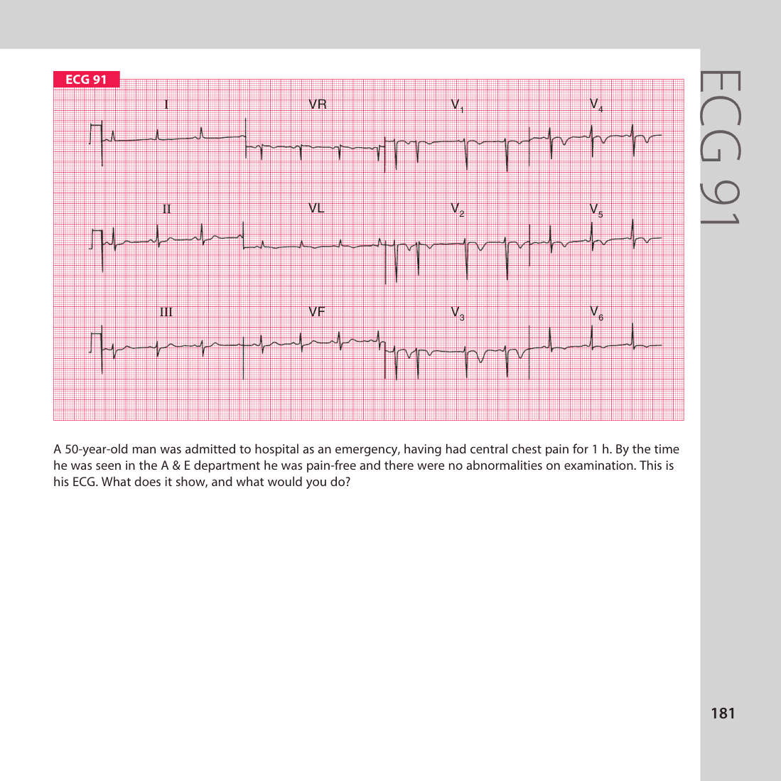 ECG 91