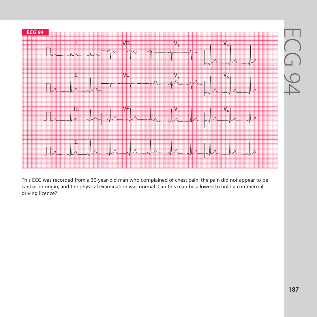 ECG 94