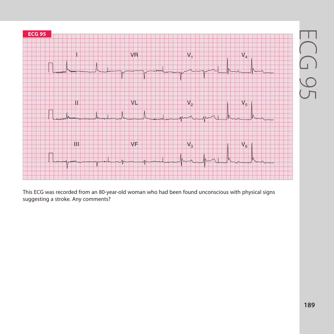 ECG 95