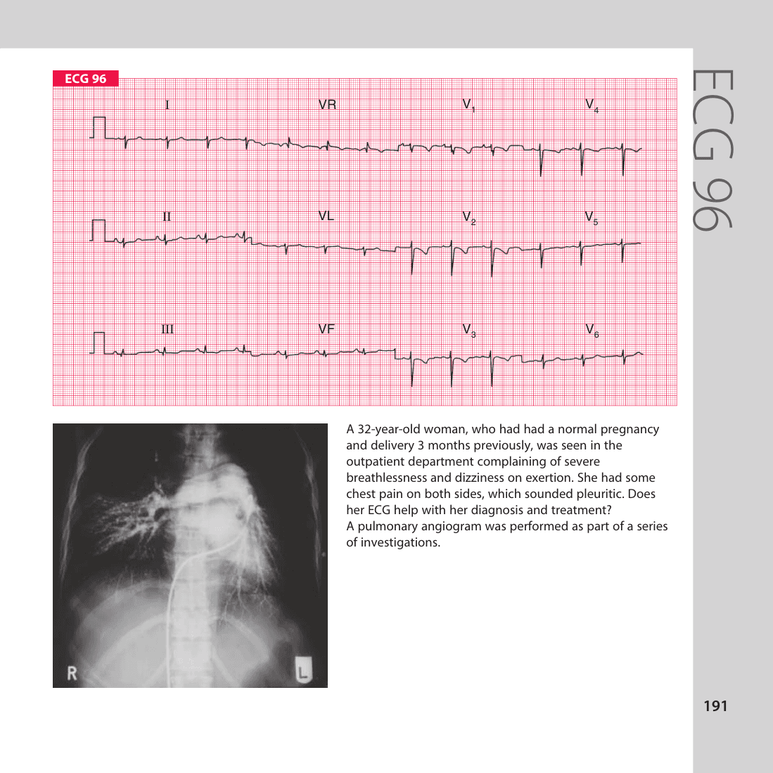 ECG 96