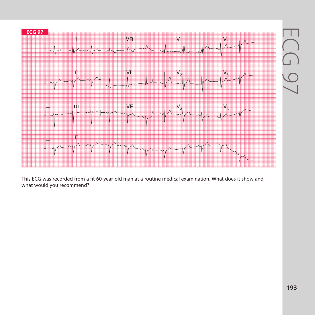 ECG 97