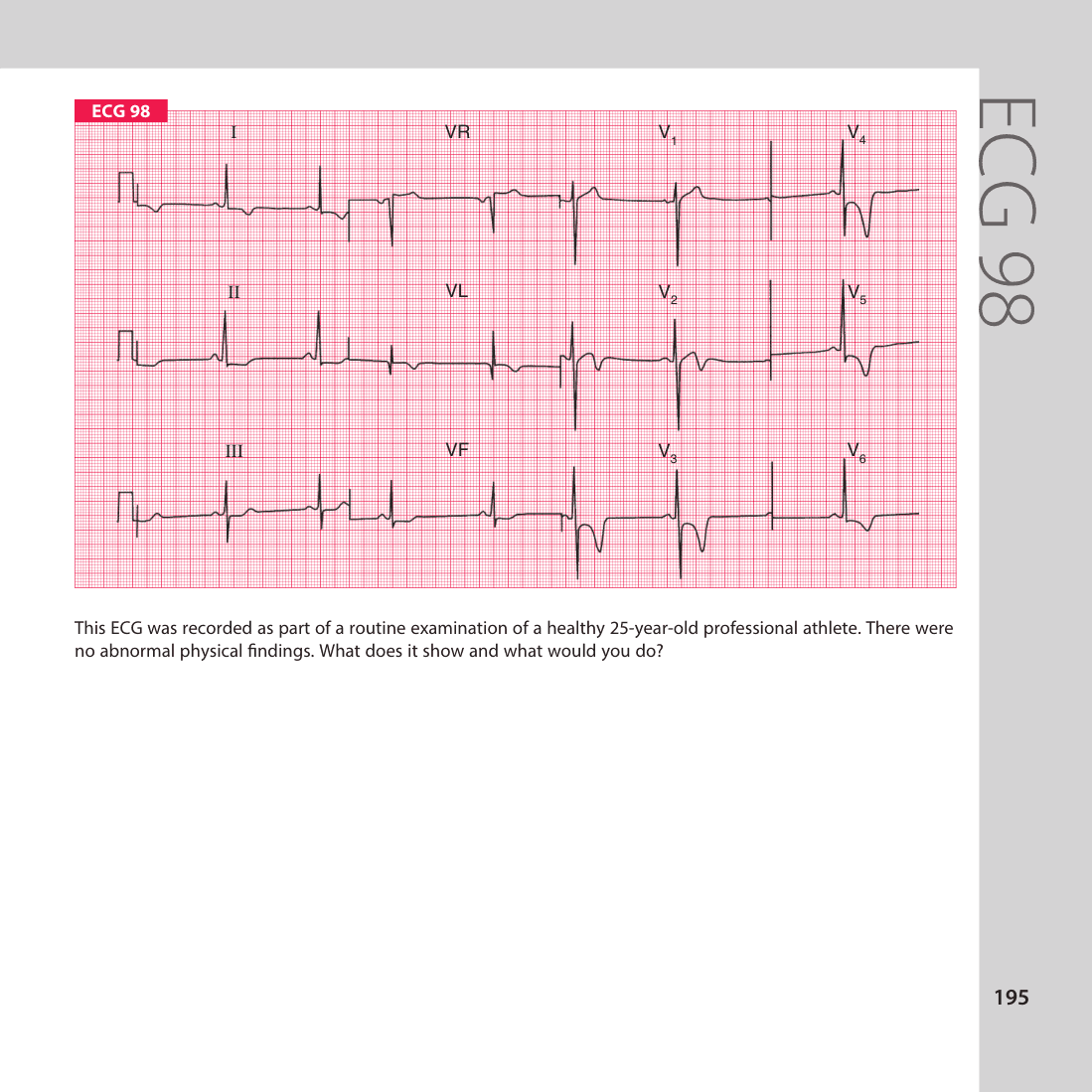ECG 98