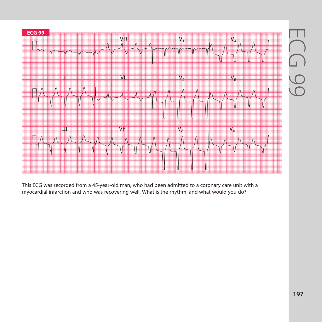 ECG 99