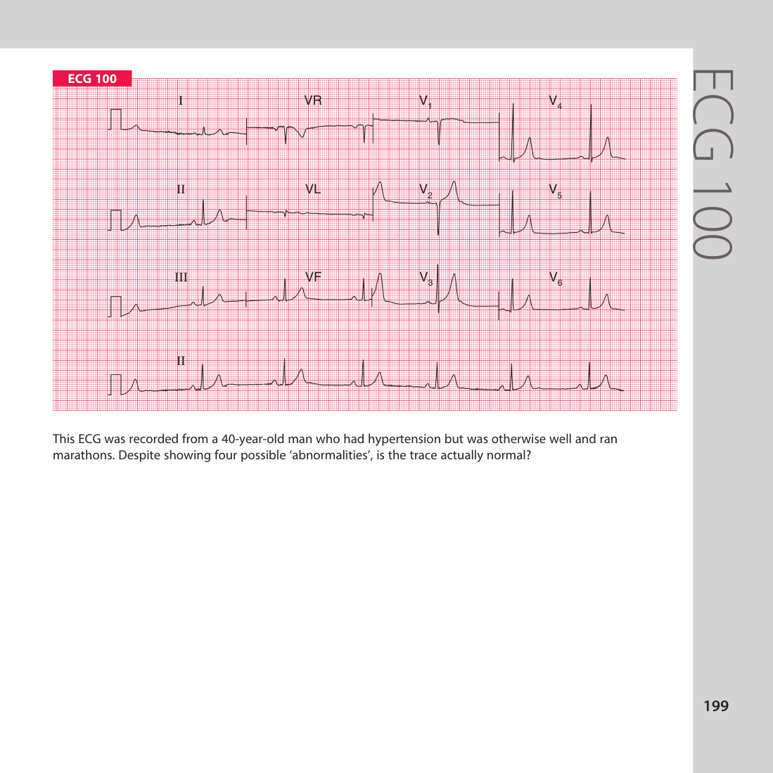 ECG 100