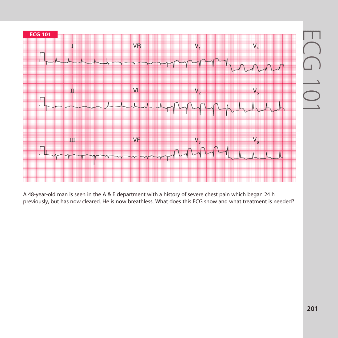 ECG 101