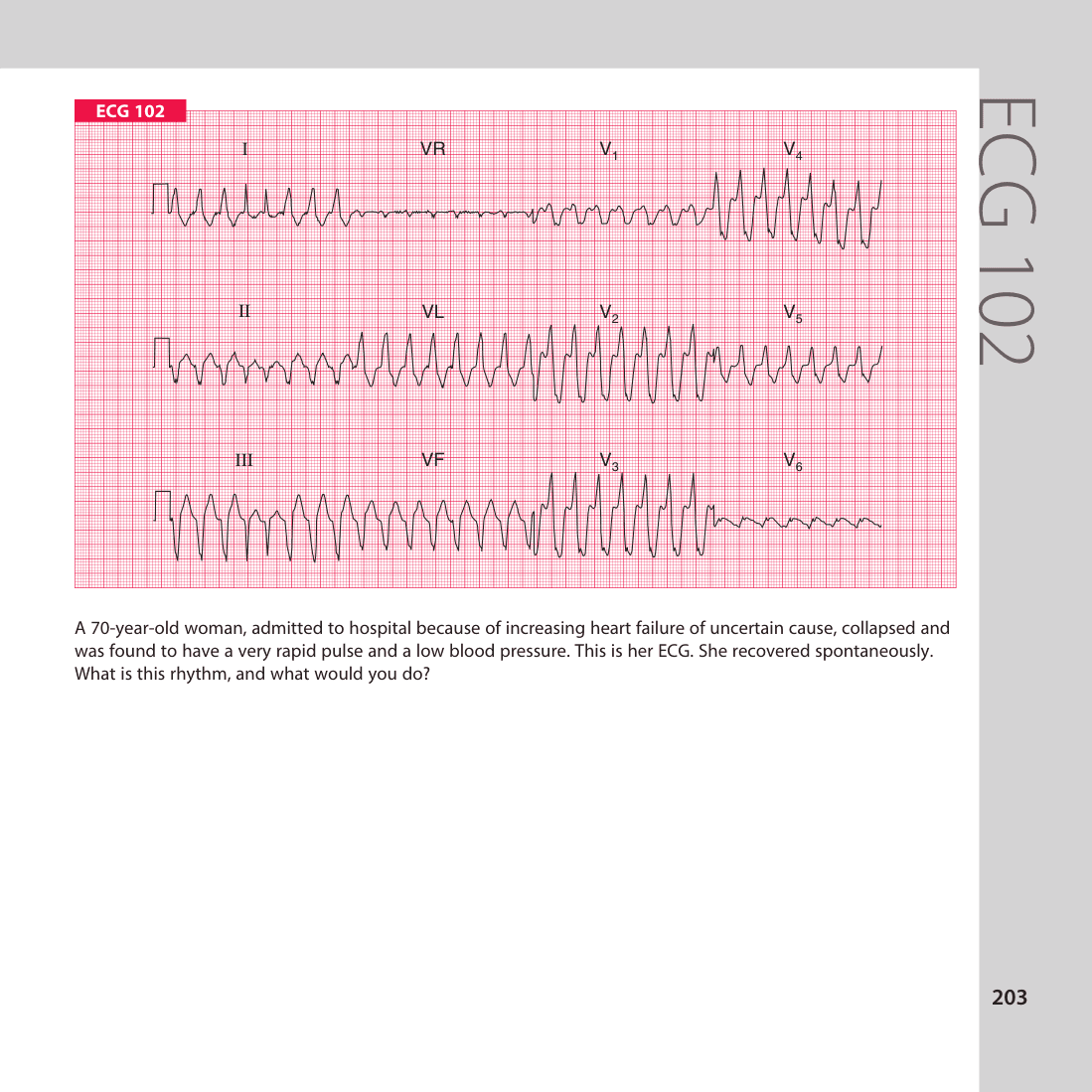 ECG 102