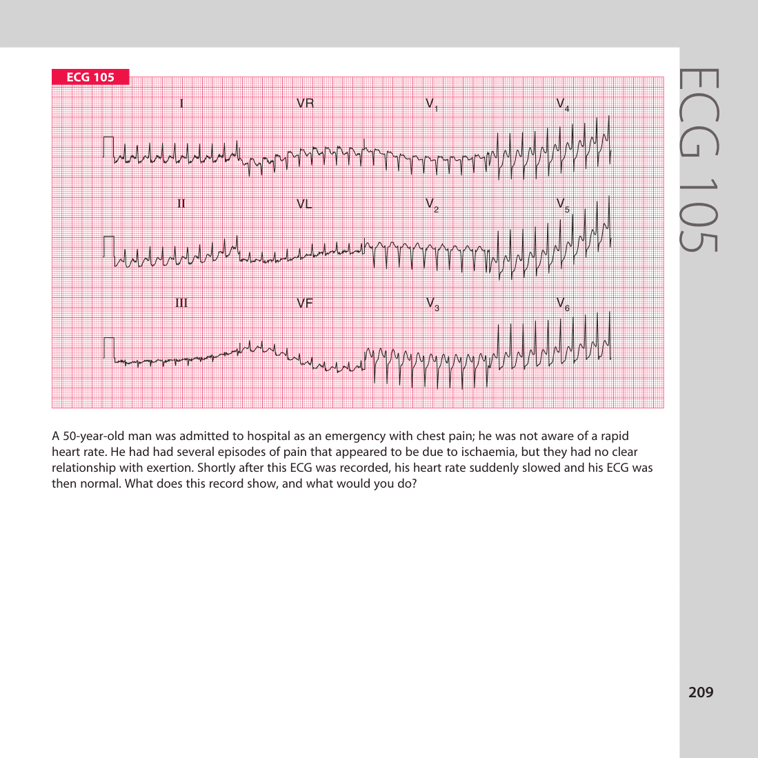 ECG 105