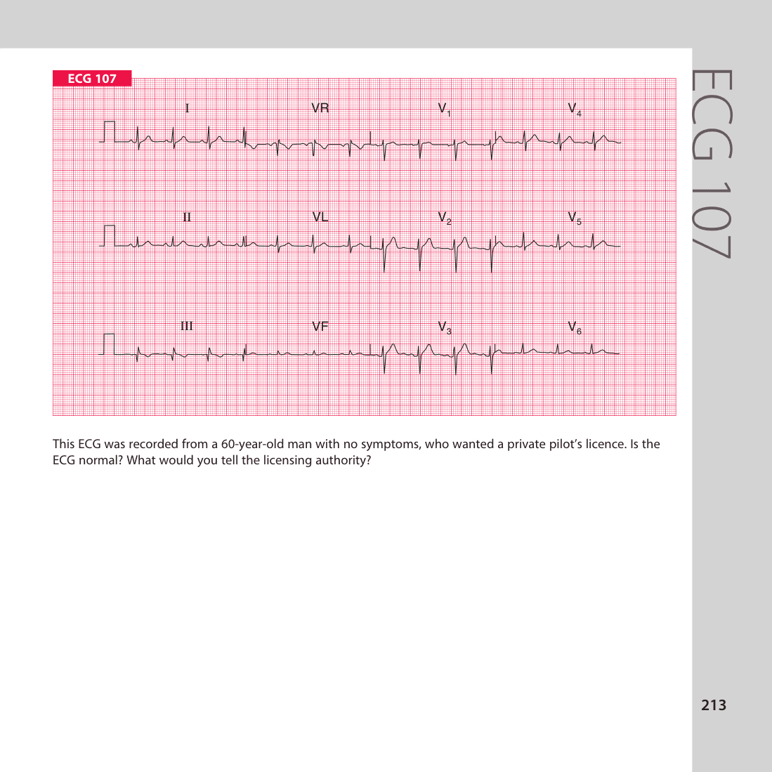 ECG 107