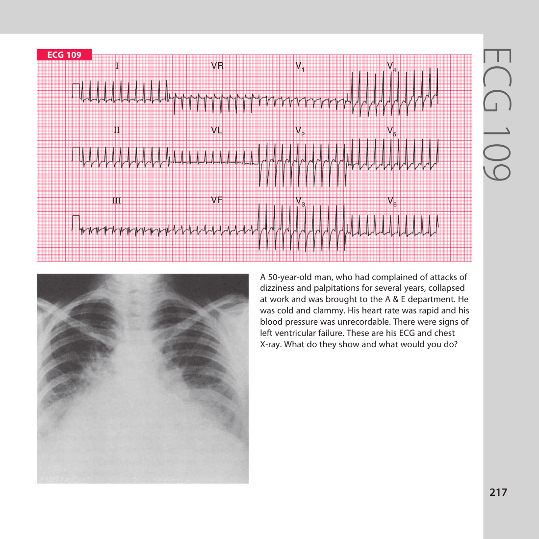 ECG 109