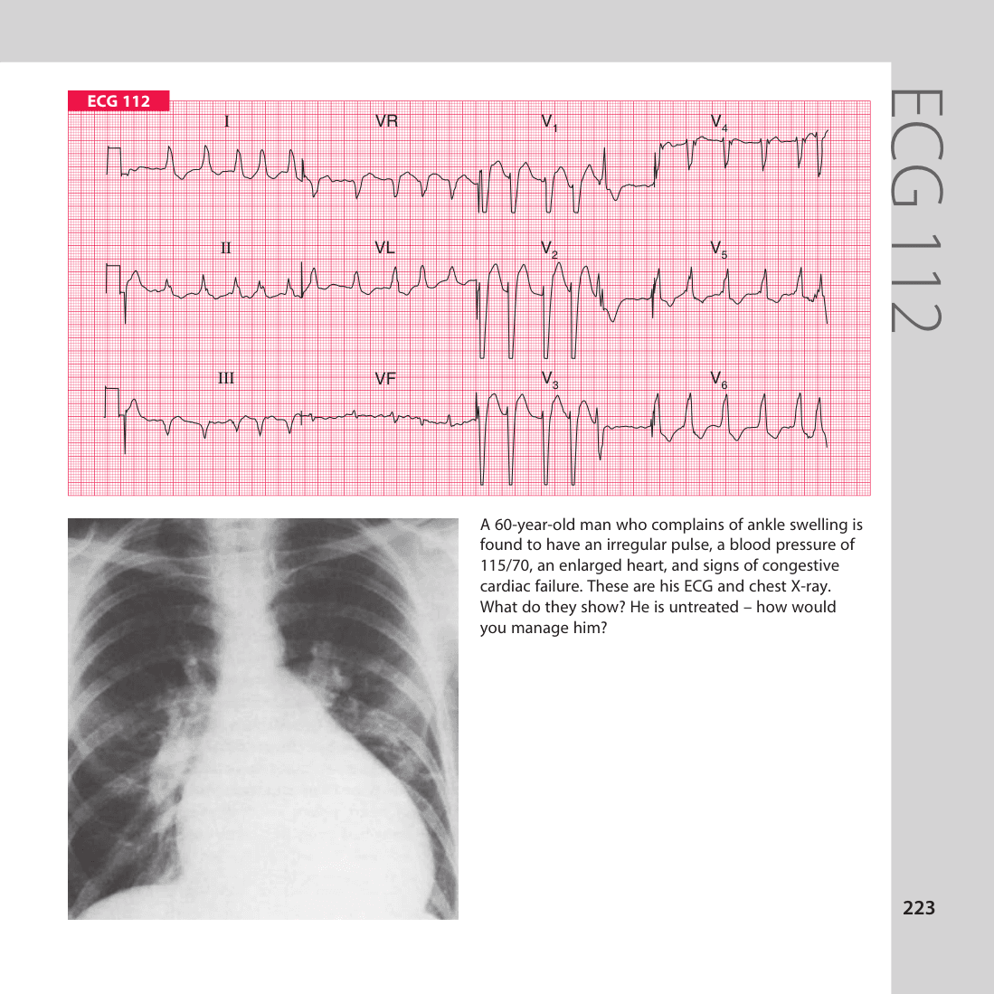 ECG 112