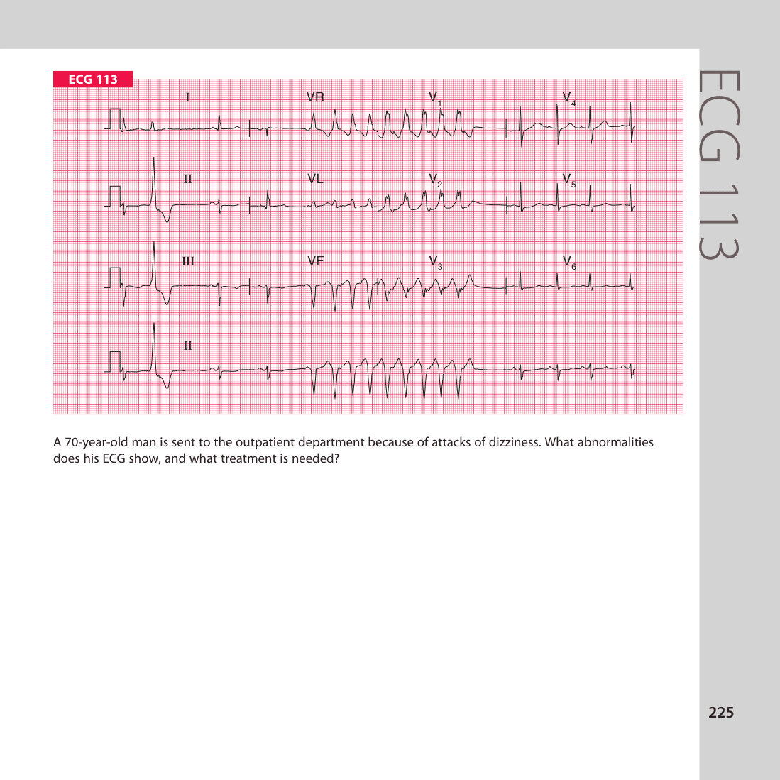 ECG 113