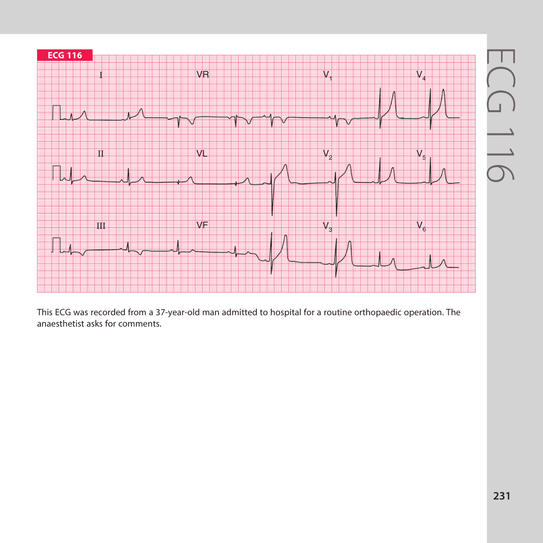 ECG 116