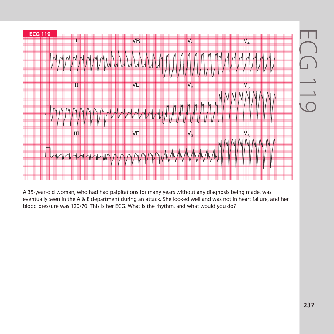 ECG 119