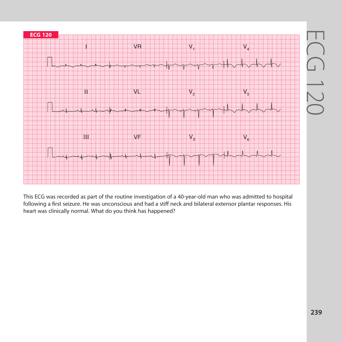 ECG 120