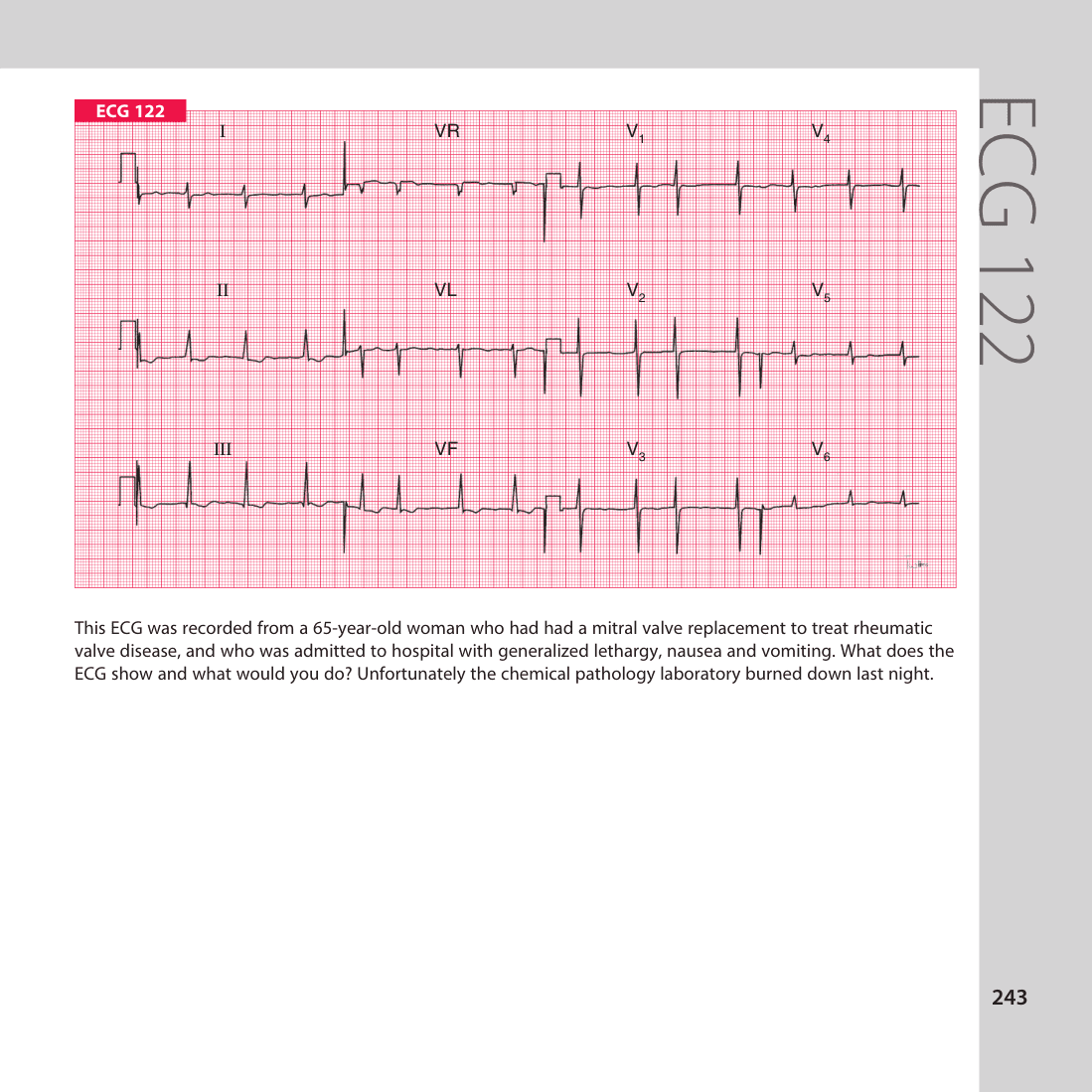 ECG 122