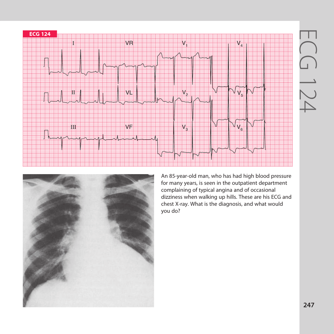 ECG 124