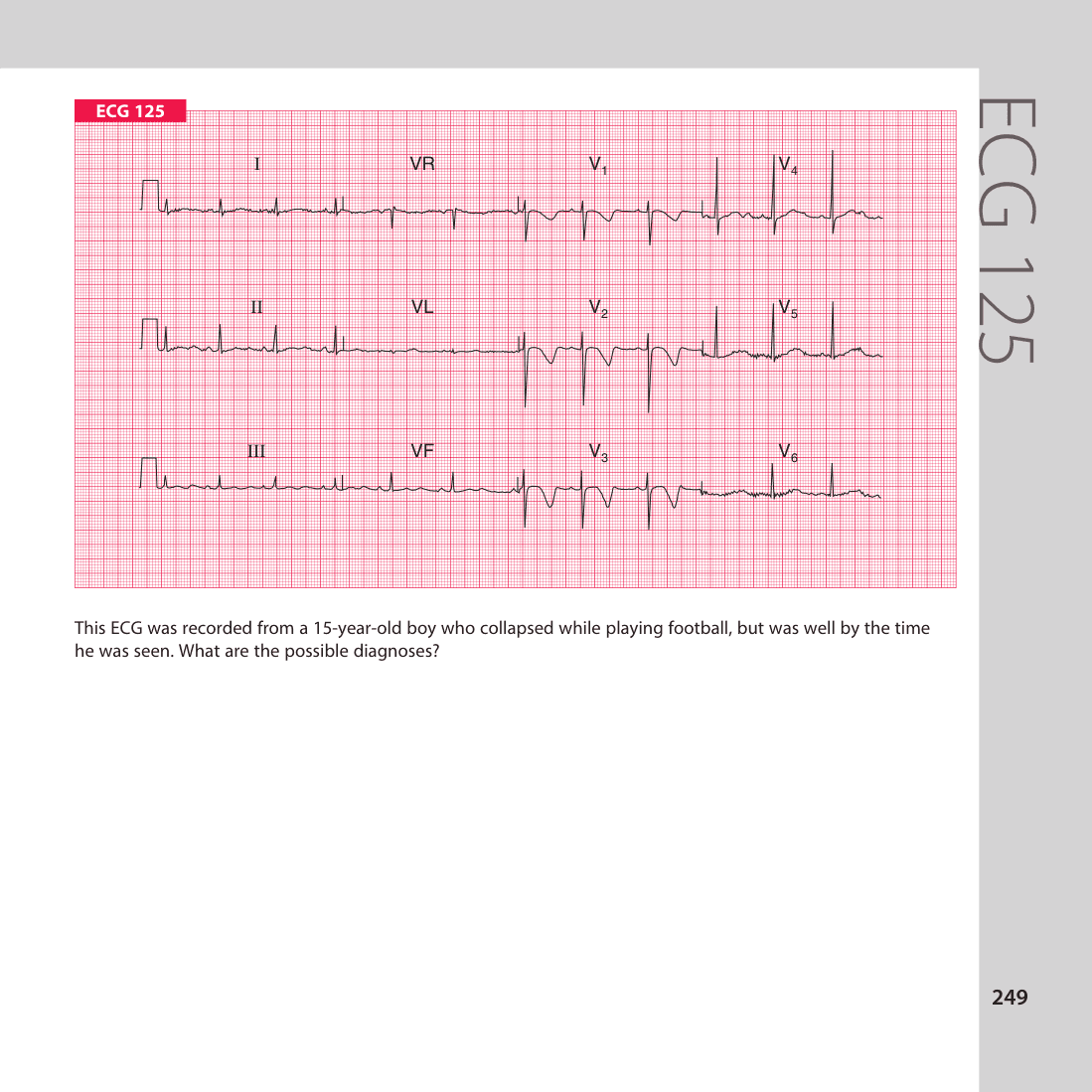 ECG 125
