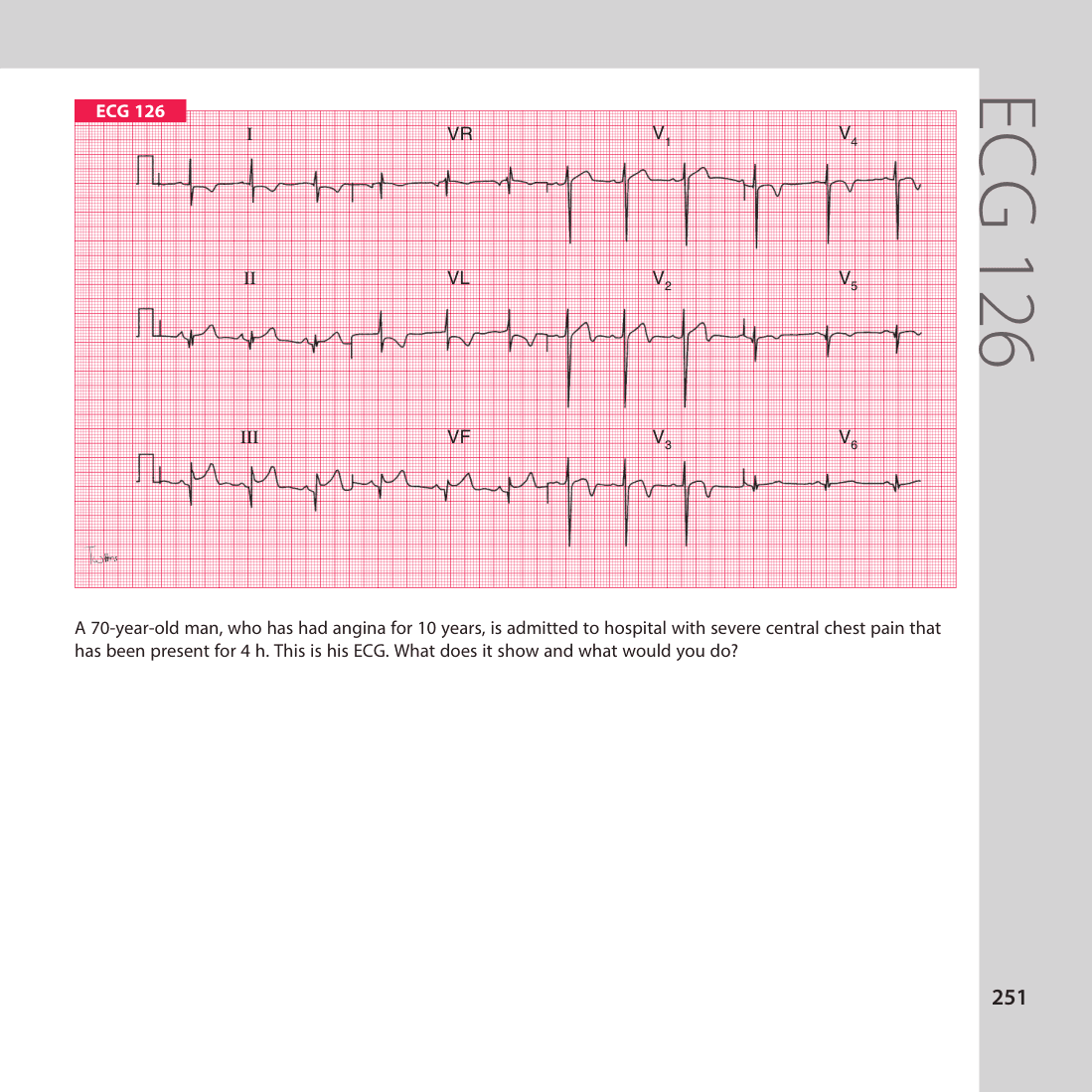 ECG 126